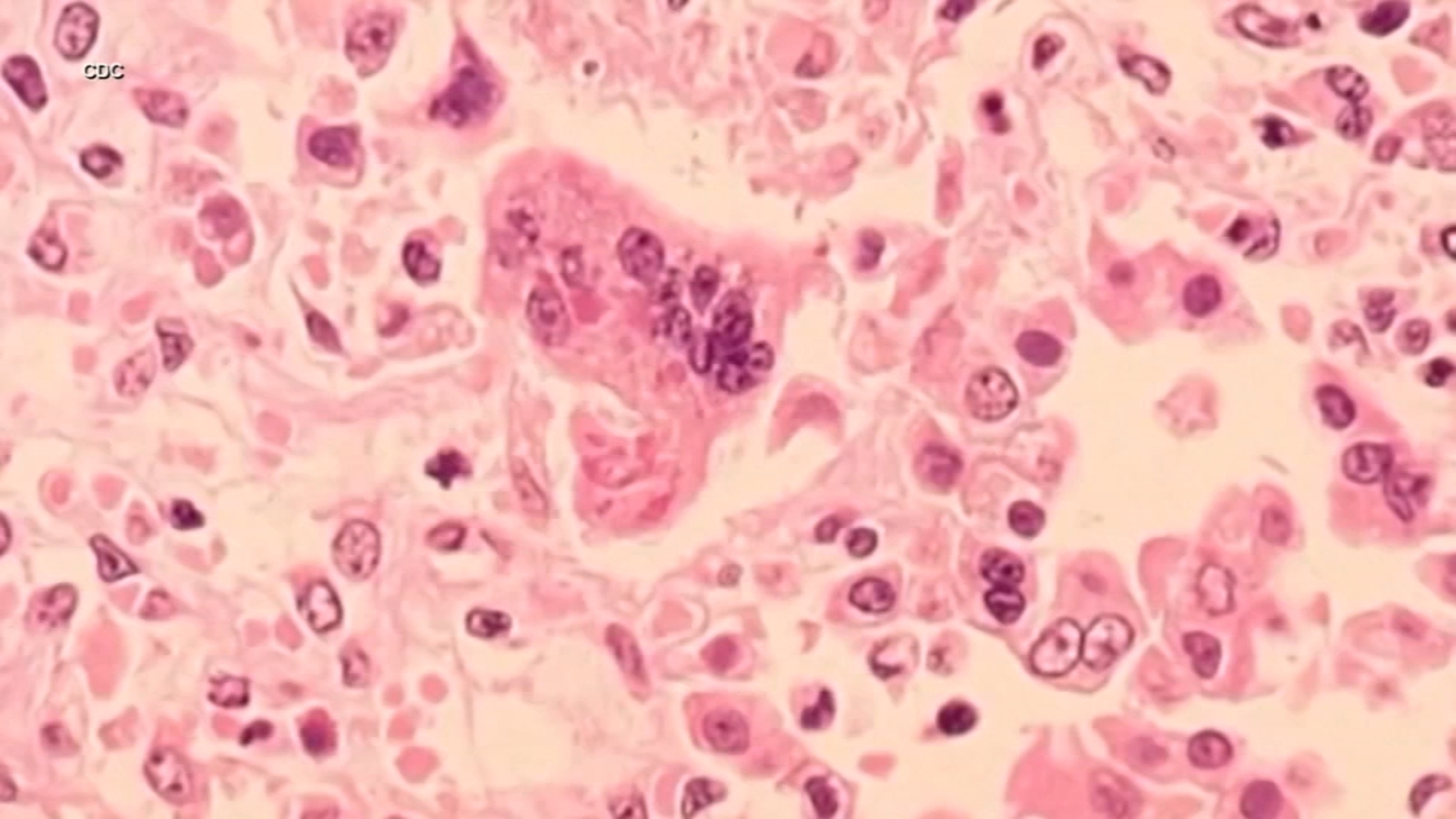 Highly-contagious measles case confirmed in Walnut Creek and Lafayette, Contra Costa County health officials say