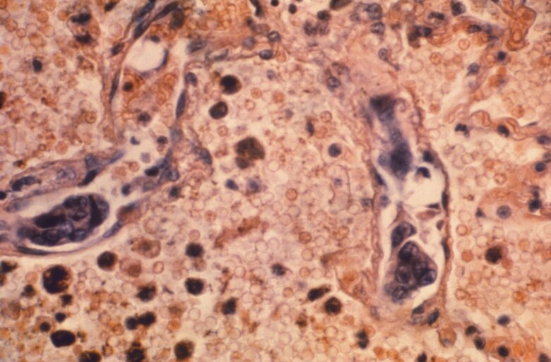 Promising results emerge from blood tests that screen for 50 cancers at once