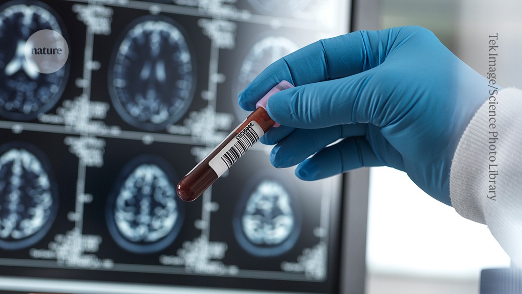How common is Alzheimer’s? Blood-test study holds surprises