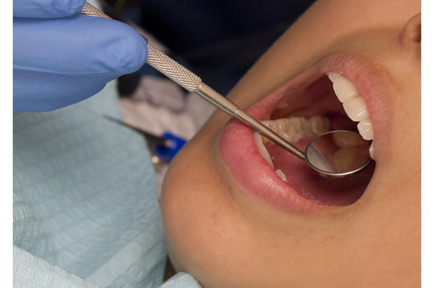 Gum disease may be linked to plaque buildup in arteries, higher risk of major CVD events