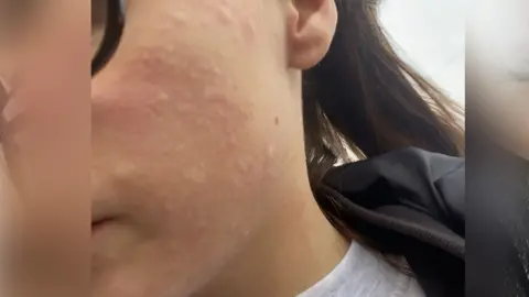 PA Media Amber's face up close with hives all over her cheek. She is wearing a round neck grey top and dark rimmed glasses