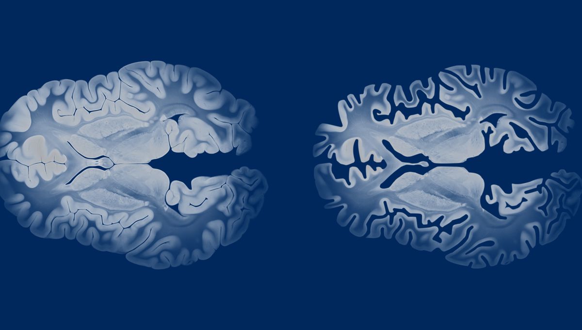 Experimental Alzheimer’s Drug NU-9 Could Have The Power To Halt Disease Before Symptoms Even Start