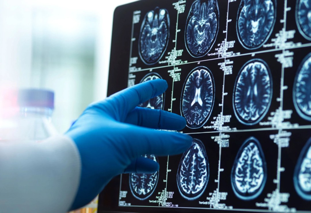 Alzheimer’s Diagnosis at 57 Shows Power of Intervention