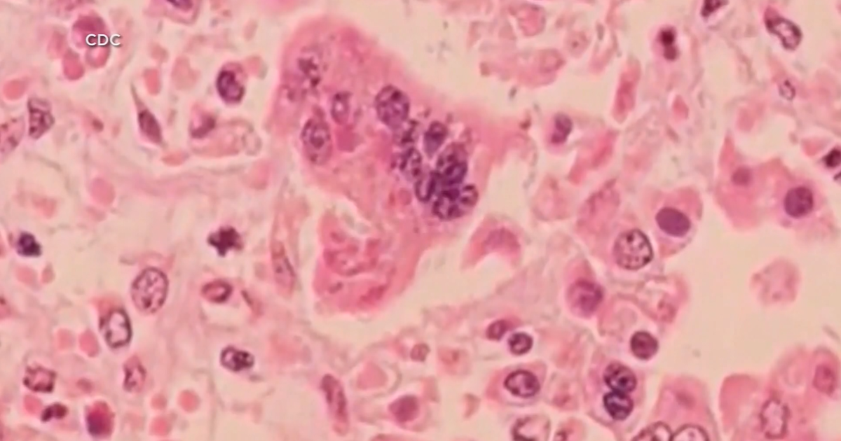 Over 50 cases of measles confirmed at Ave Maria University – WINK News