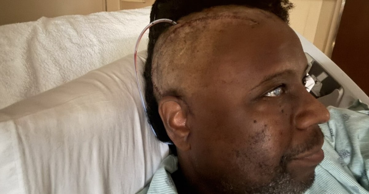 Dad, 48, Reveals 2 Sudden Symptoms That Led to ‘Huge’ Brain Tumor Diagnosis