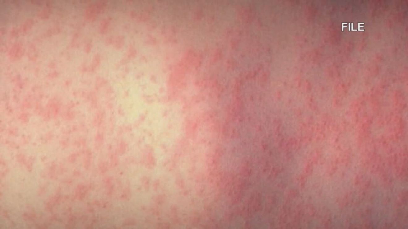 Six new measles cases reported in Clark County