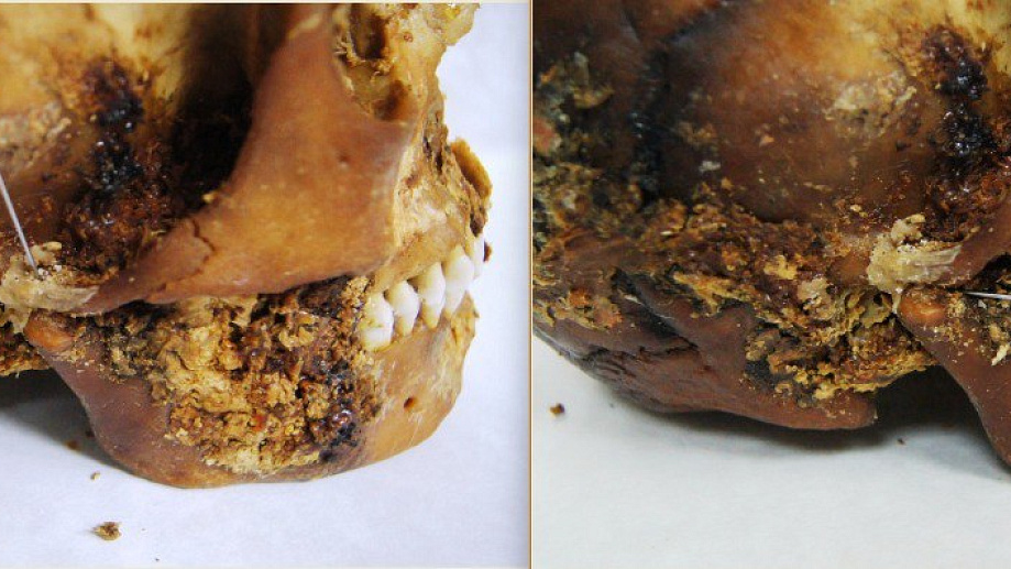 2,500-year-old ‘primitive prosthetic’ found on jaw of mummified Scythian woman who survived complex jaw surgery