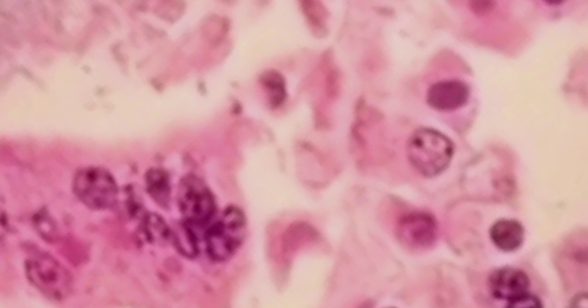 Measles outbreak in Michigan county as cases spread ‘like wildfire’