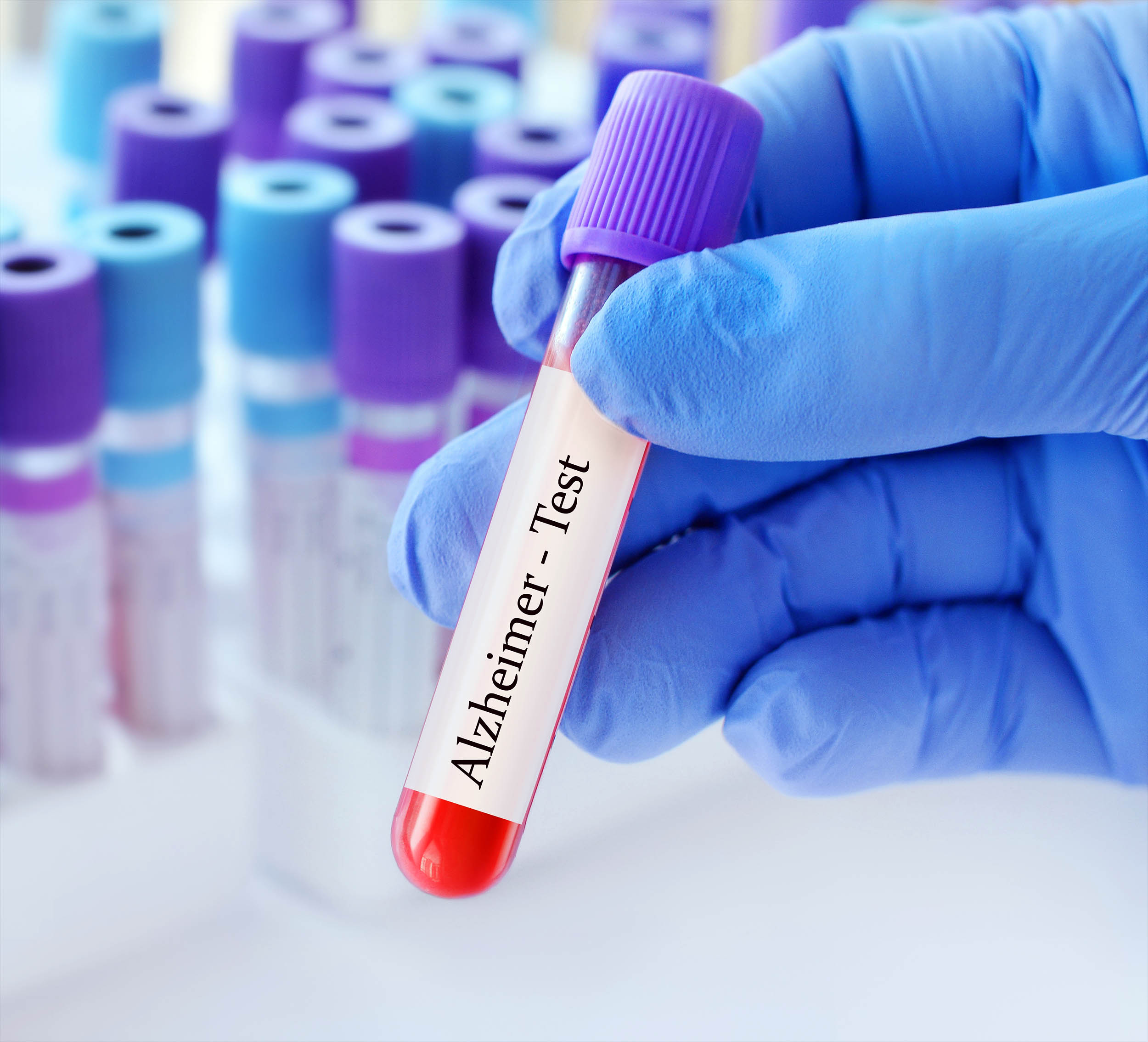 Blood test predicts dementia 25 years before symptoms appear