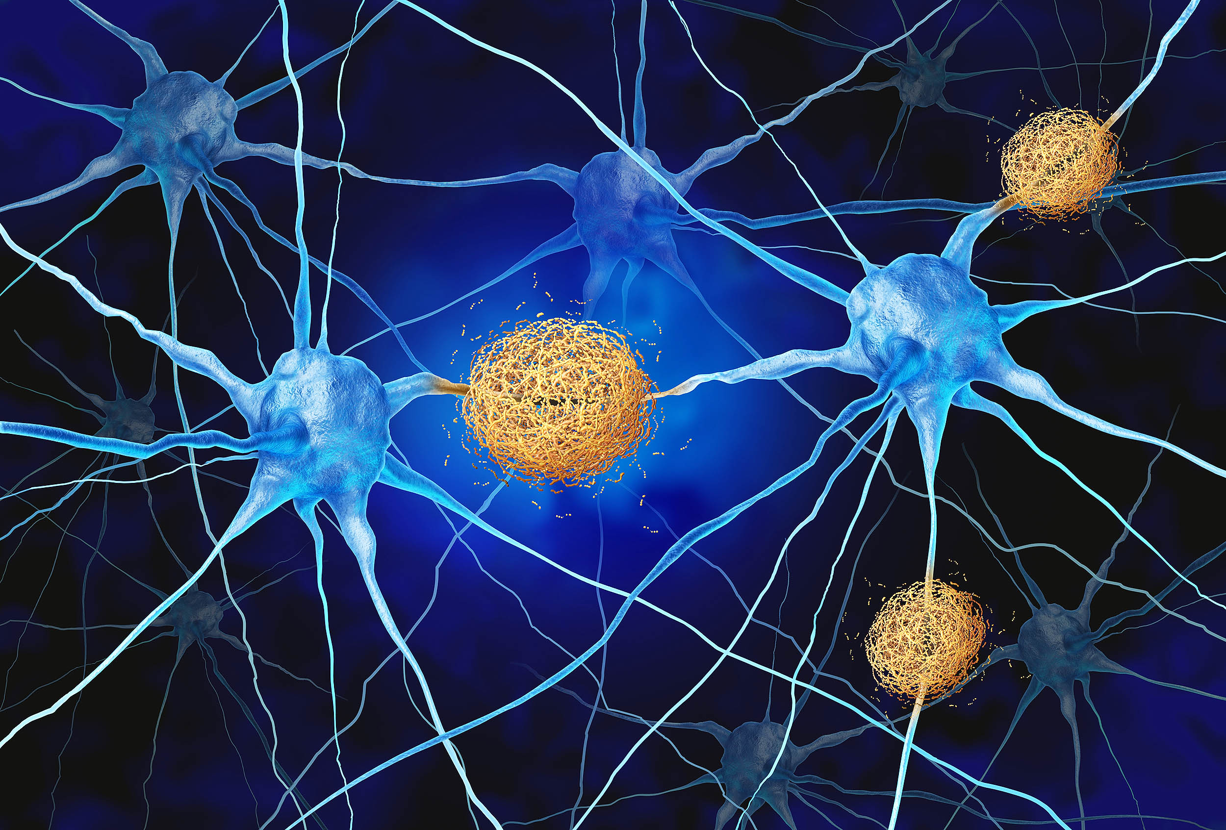 Normal brain immune cells may actually be causing Alzheimer’s