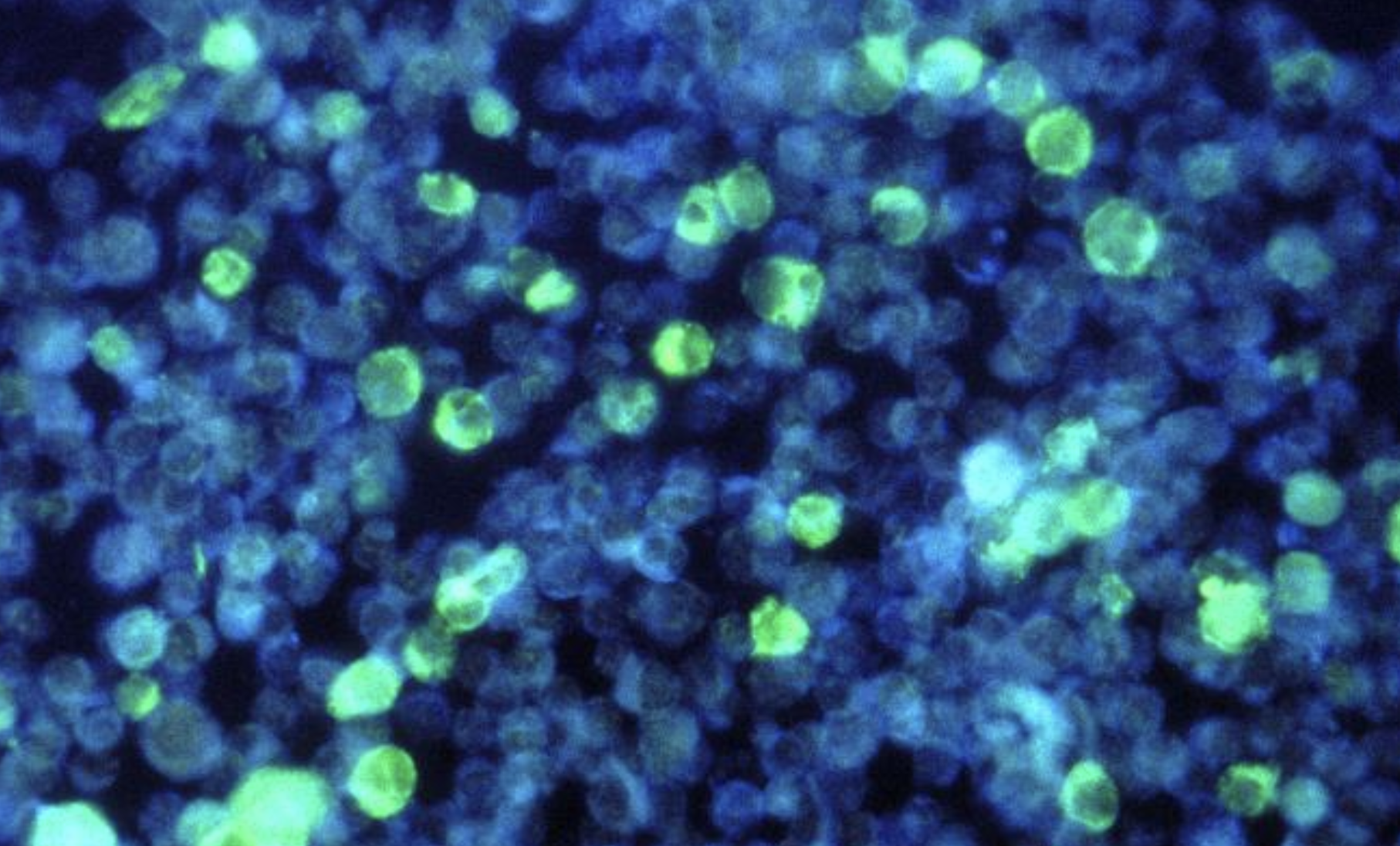 An Immune Reaction to EBV can Lead to MS-Related Brain Damage