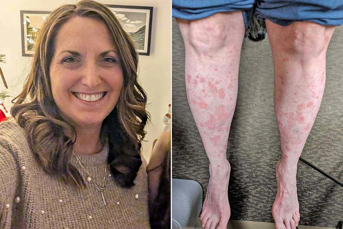Woman, 47, Suffered Physically and Emotionally for Years from Psoriasis. Then, One Decision Changed Everything (Exclusive)
