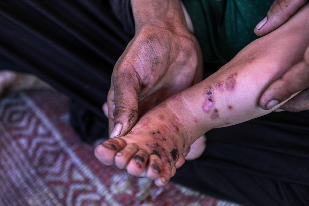 Umm Muhammad al-Masri, a Palestinian refugee and mother of five, shelters in the Al-Aqsa University building, and her 10-month-old baby, Ramadan al-Masri, suffers a bacterial skin infection transmitted through blood, in Gaza on August 12, 2025. [Abed Rahim Khatib - Anadolu Agency]