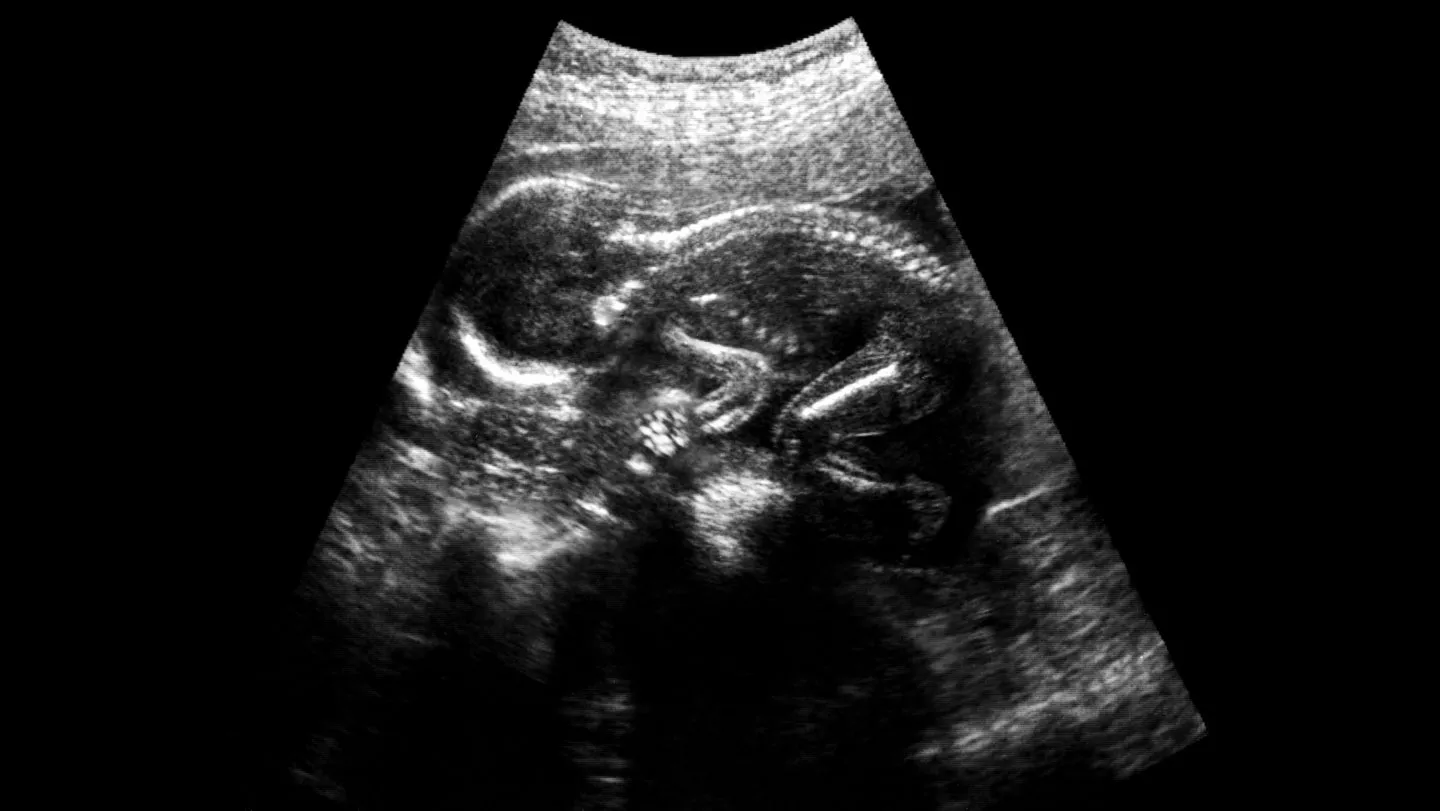 Prenatal surgery for spina bifida may get a boost from stem cells