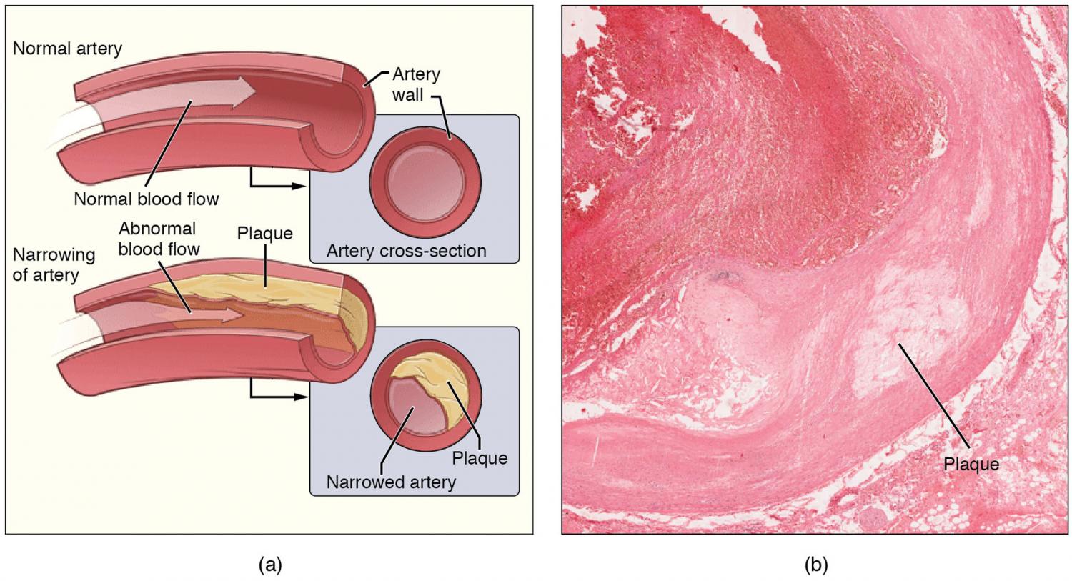 Blood vessels activate self-defense response that may slow atherosclerosis progression