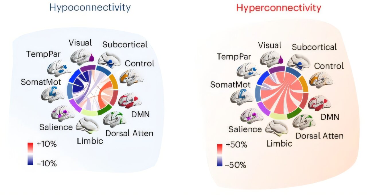 Autism may have two distinct subtypes based on brain connectivity patterns