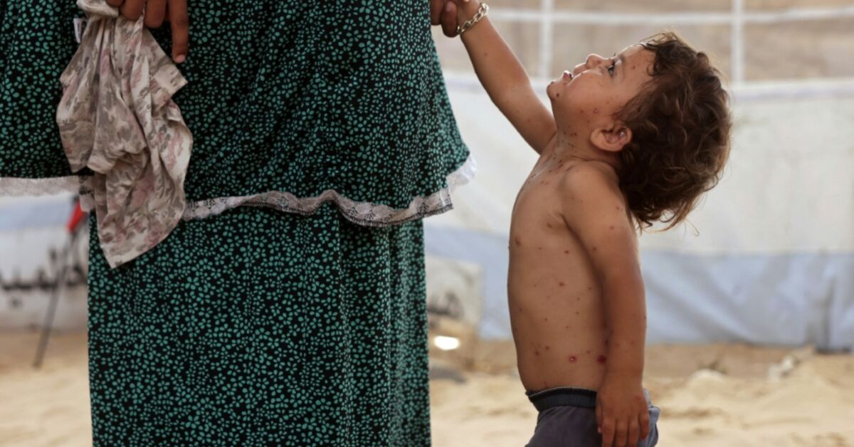 ‘All these rashes’: chickenpox surges in Gaza camps