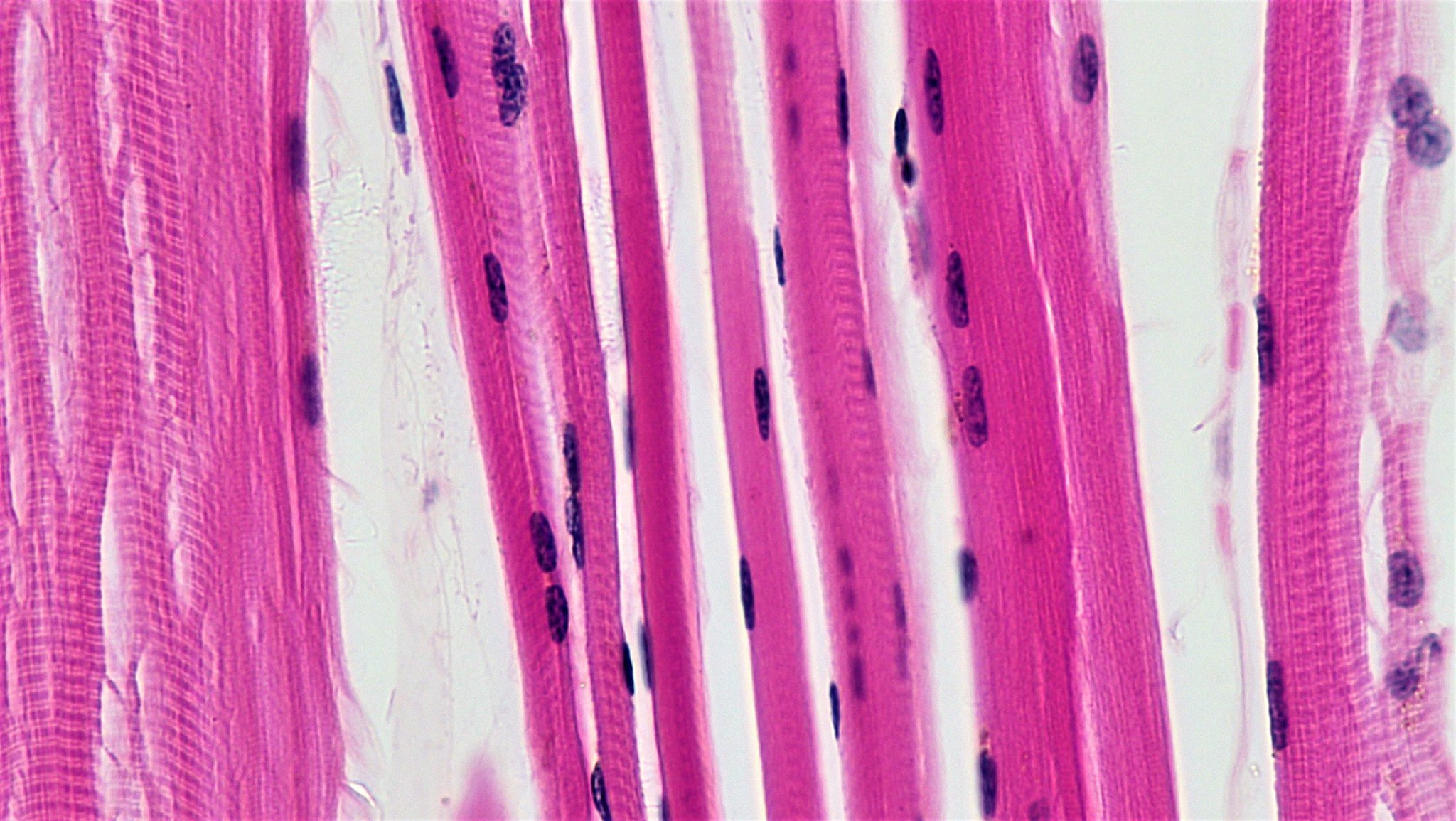 Dialing back stiffness may protect muscles in myotonic dystrophy