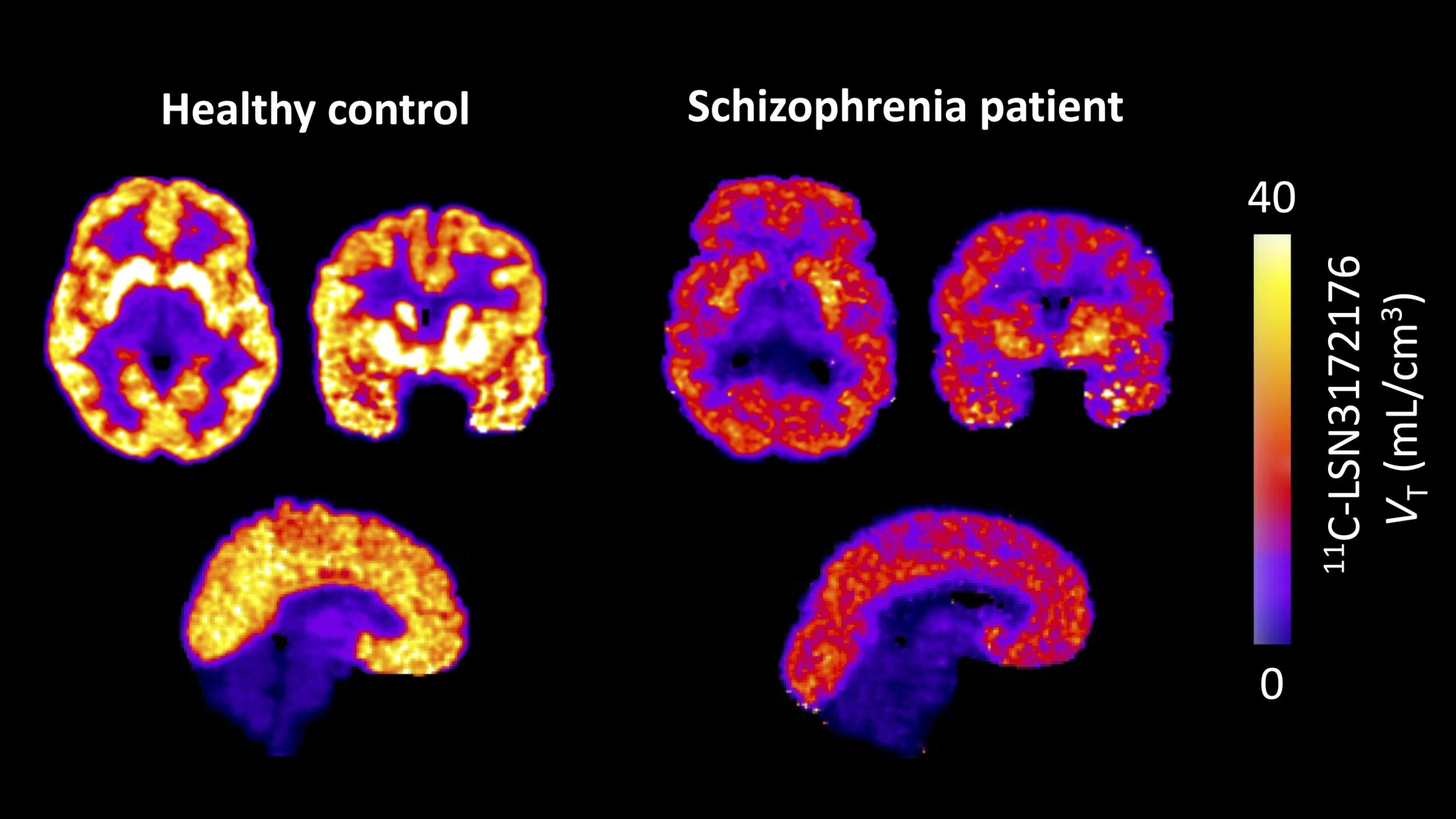 Brain imaging now reveals receptor dysfunction in living patients with schizophrenia