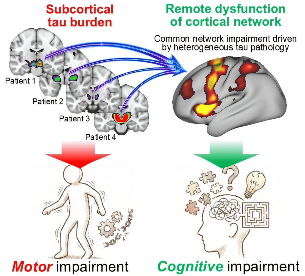Brain circuits may help explain cognitive symptoms in progressive supranuclear palsy